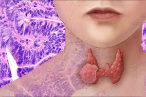 Les scientifiques de l'USP sont des pionniers dans l'édition de l'ADN agressif des tumeurs thyroïdiennes – Jornal da USP