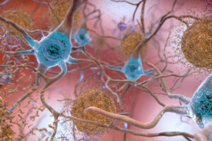 Les patients atteints de la maladie d&rsquo;Alzheimer peuvent compter sur l&rsquo;assistance du réseau de santé municipal du SP – Jornal da USP