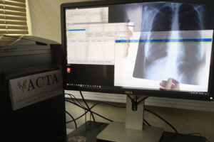 Un logiciel aide à prédire la mortalité chez les patients ayant eu une embolie pulmonaire aiguë – Jornal da USP