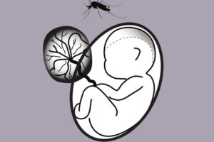 Une étude suggère un marqueur pour le diagnostic de la microcéphalie à Zika chez les nouveau-nés par plasma – Jornal da USP