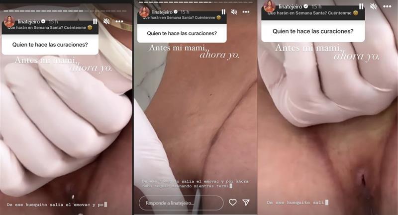 Résultats de la chirurgie biopolymère, voici comment Lina Tejeiro est drainée.  Photo : Instagram @linatejeiro
