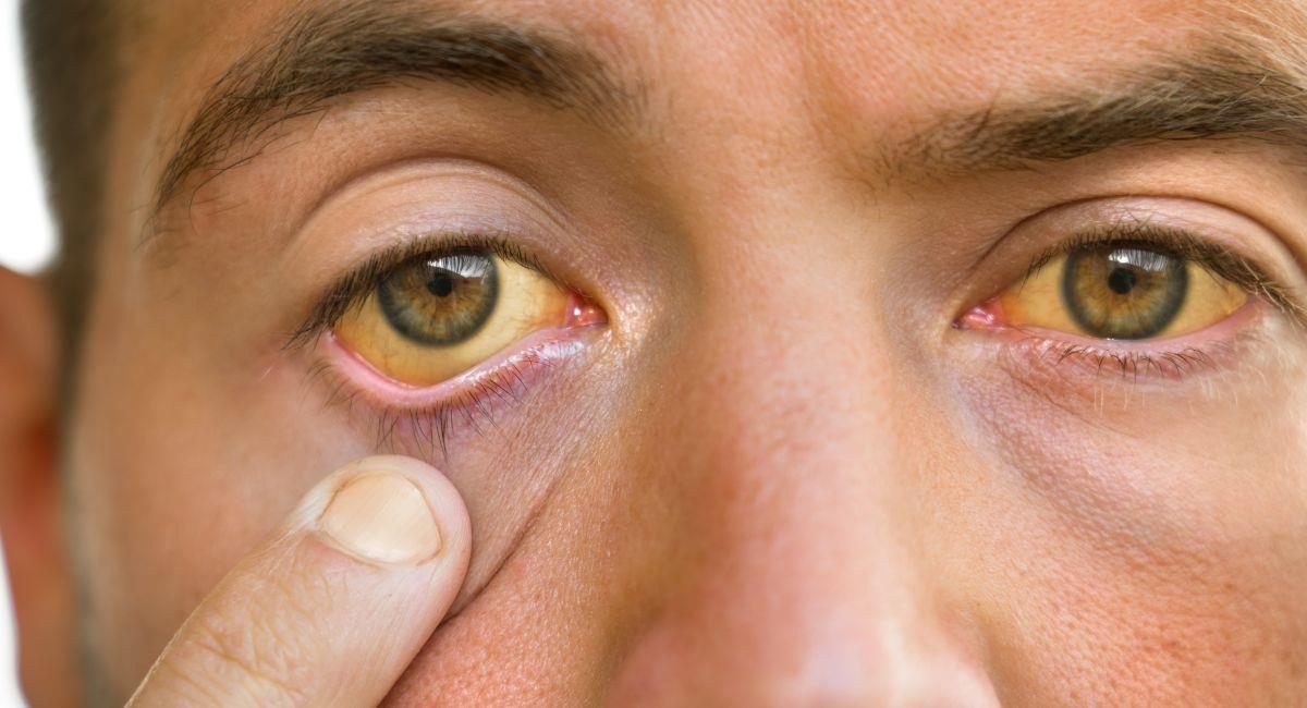 Medellín en alerta por incremento de casos de Hepatitis A. Foto: Shutterstock