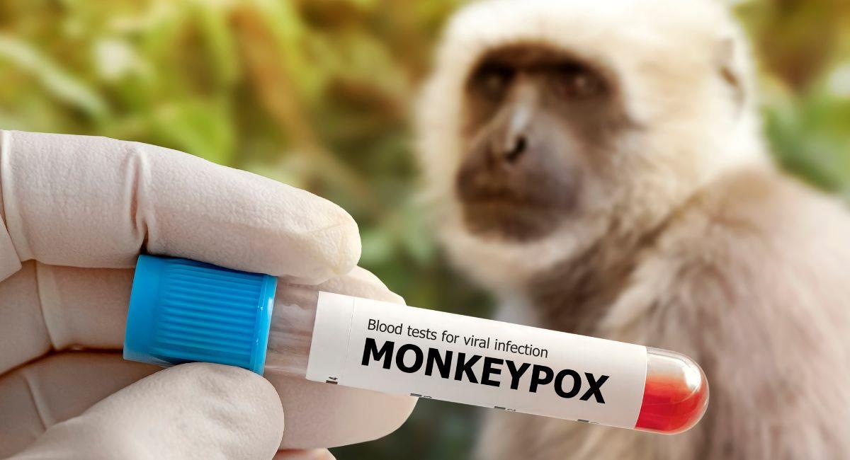 ¡Pare bolas! Nueva cepa de la Viruela del Mono preocupa a la OMS. Foto: Shutterstock