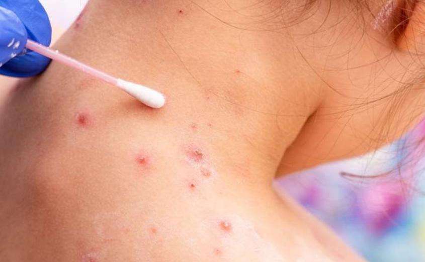 Il existe 30 agents pathogènes susceptibles de provoquer une pandémie