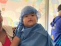 Début des séances de chirurgie maxillo-faciale pour enfants au HCM