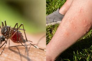 Sang doux ou groupe sanguin ? Ce que dit la science sur les raisons pour lesquelles les moustiques vous piquent